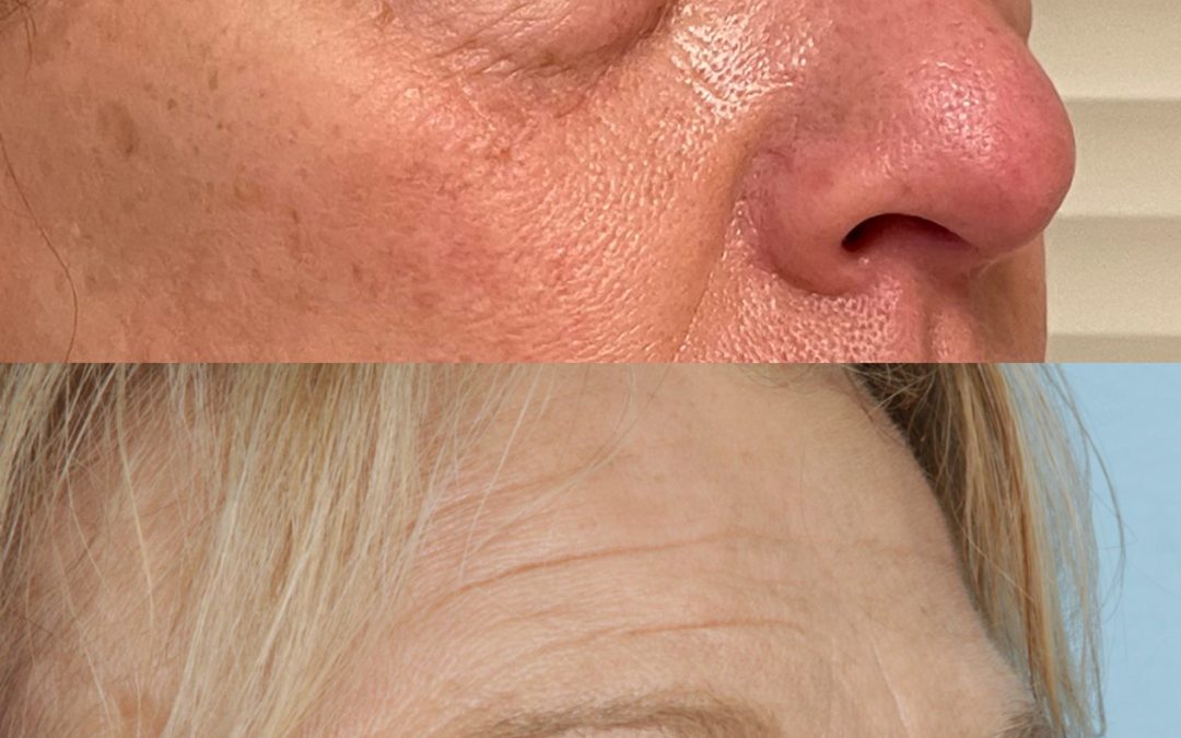 Upper and Lower Blepharoplasty – Eyelid Lift