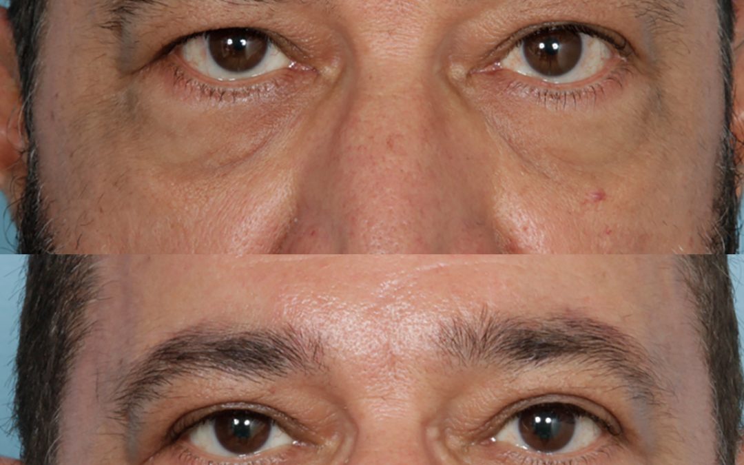 Male Upper Blepharoplasty (Eyelid Lift)
