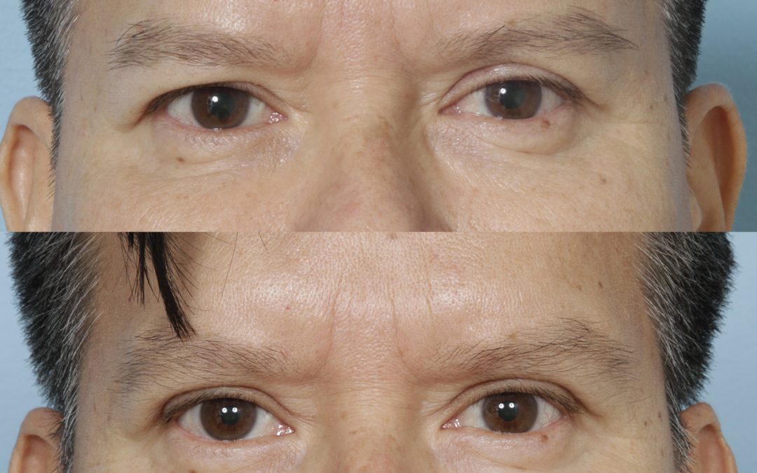 Male Upper Blepharoplasty (Eyelid Lift)