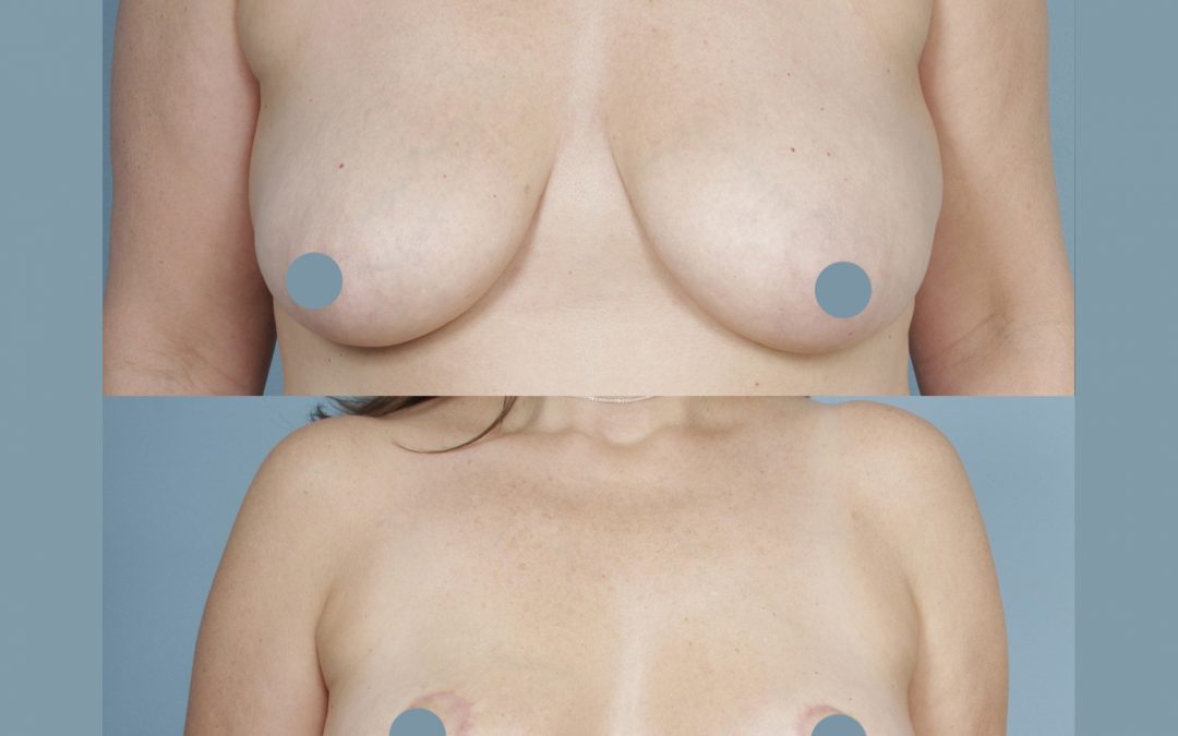Breast Lift by Dr Sergey Turin
