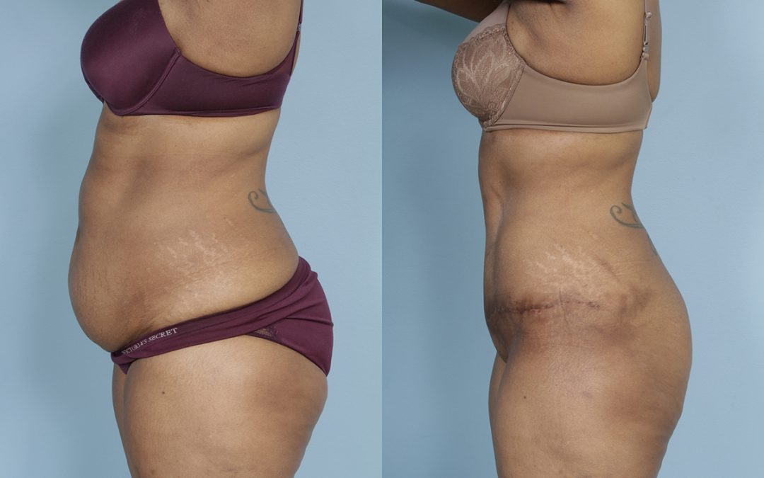 Tummy Tuck (Abdominoplasty) by Dr. Sergey Turin