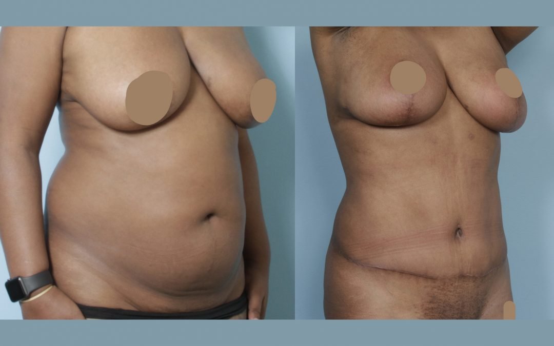 Tummy Tuck (Abdominoplasty) by Dr. Sergey Turin