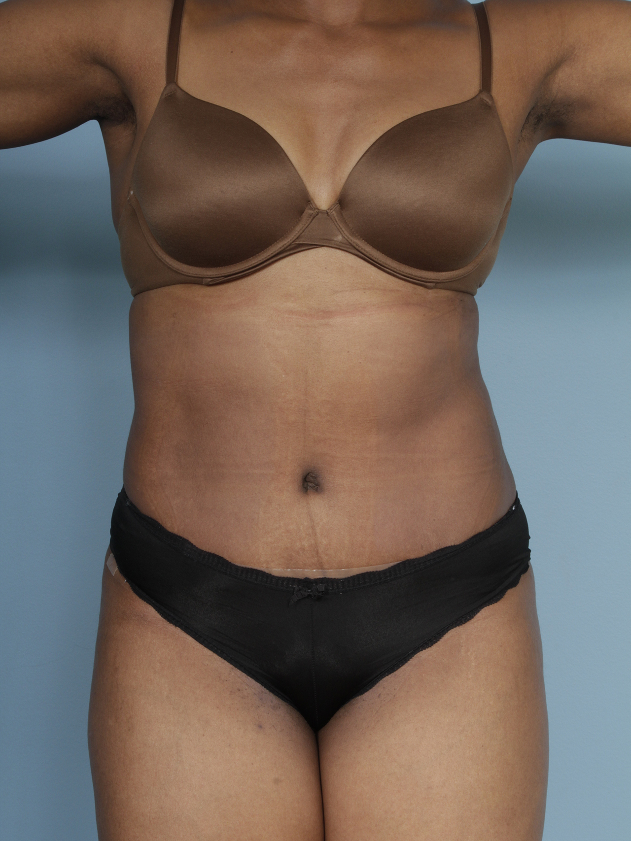 Dr Turin Tummy Tuck