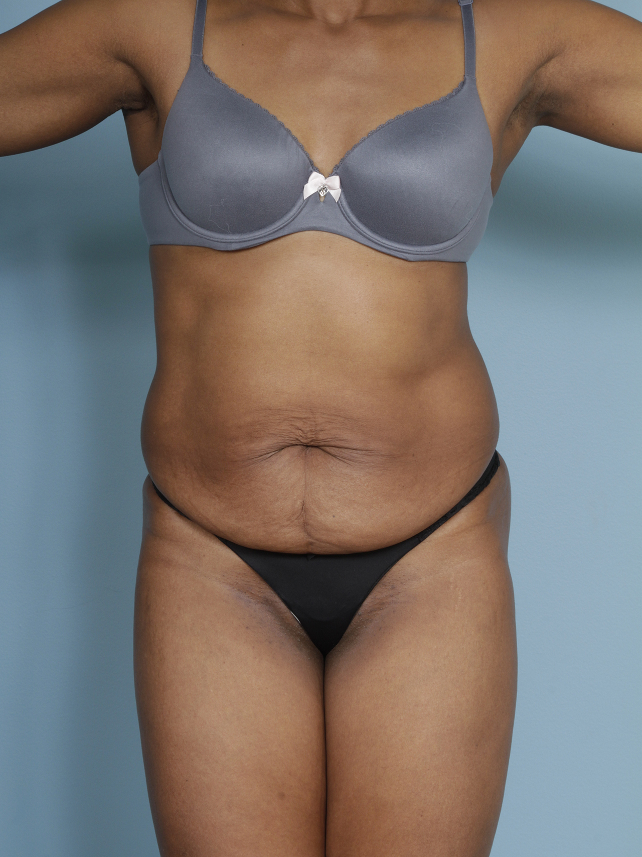 Dr Turin Tummy Tuck