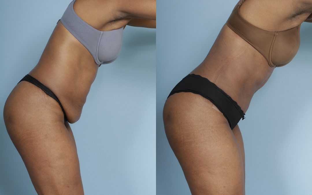 Tummy Tuck (Abdominoplasty) by Dr. Sergey Turin