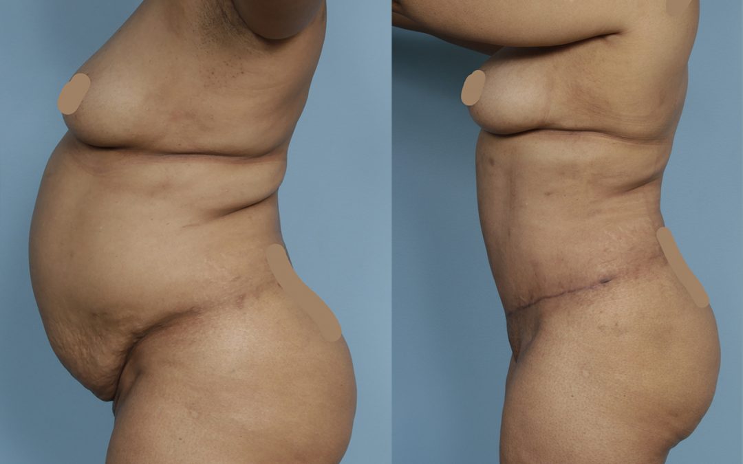Tummy Tuck (Abdominoplasty)