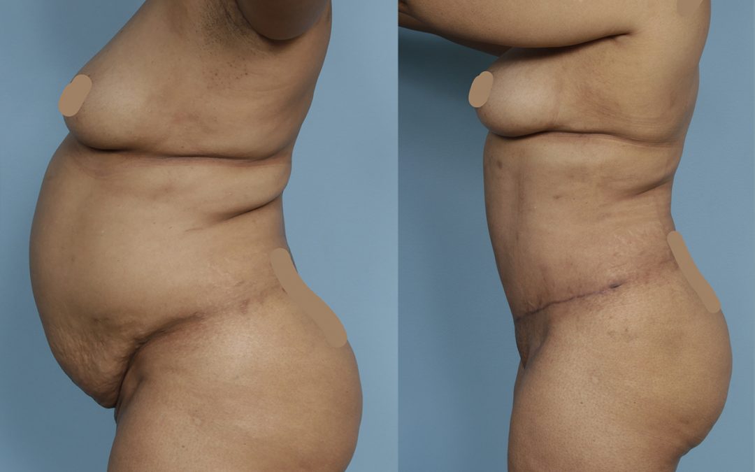 Tummy Tuck (Abdominoplasty) By Dr. Sergey Turin