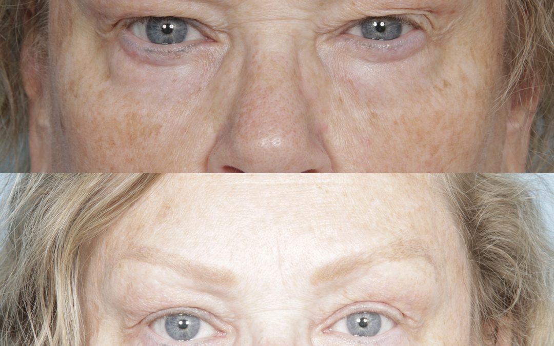 Upper Blepharoplasty (Eyelid Lift)