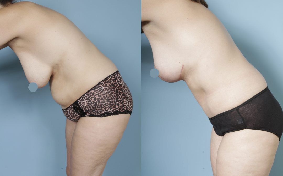 Mommy Makeover by Dr Sergey Turin – tummy tuck and breast lift